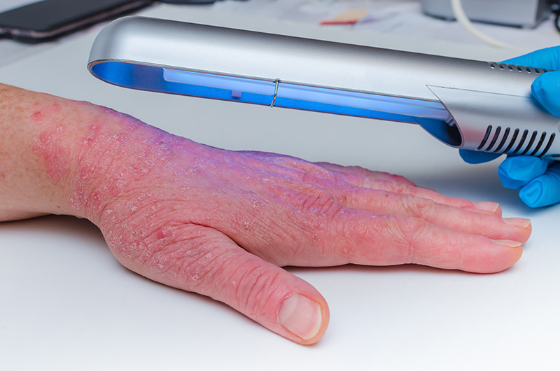 A Dermatologist treating severe eczema using phototherapy.